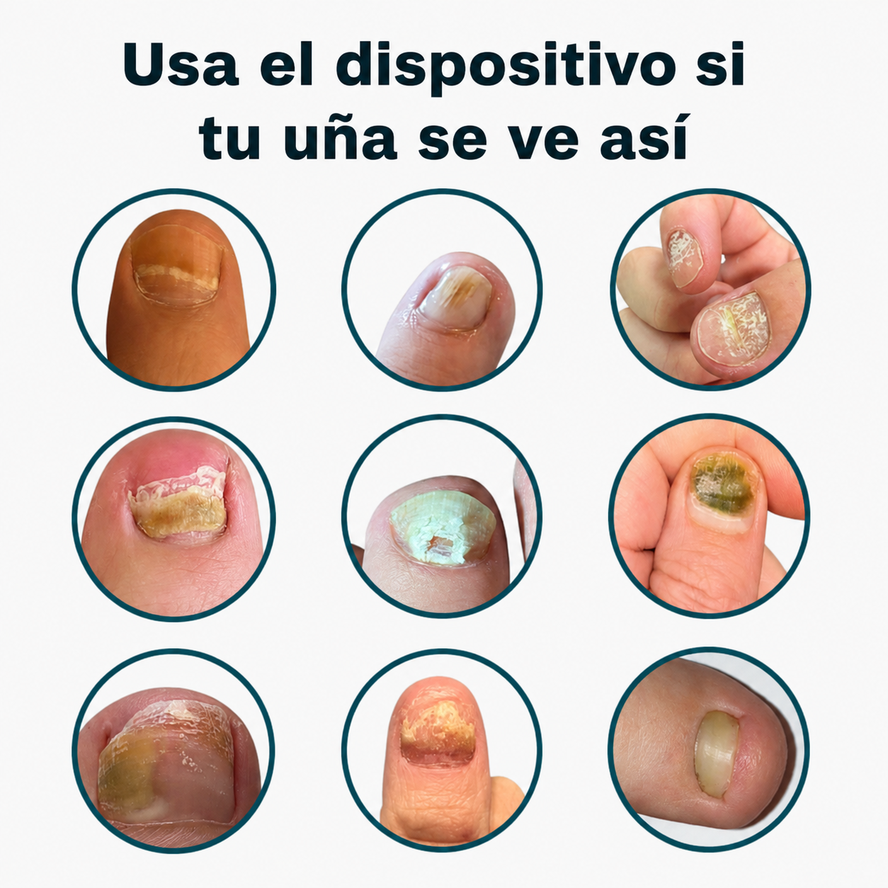 CuraVida - tratamiento con luz azul para los hongos en las uñas desde casa