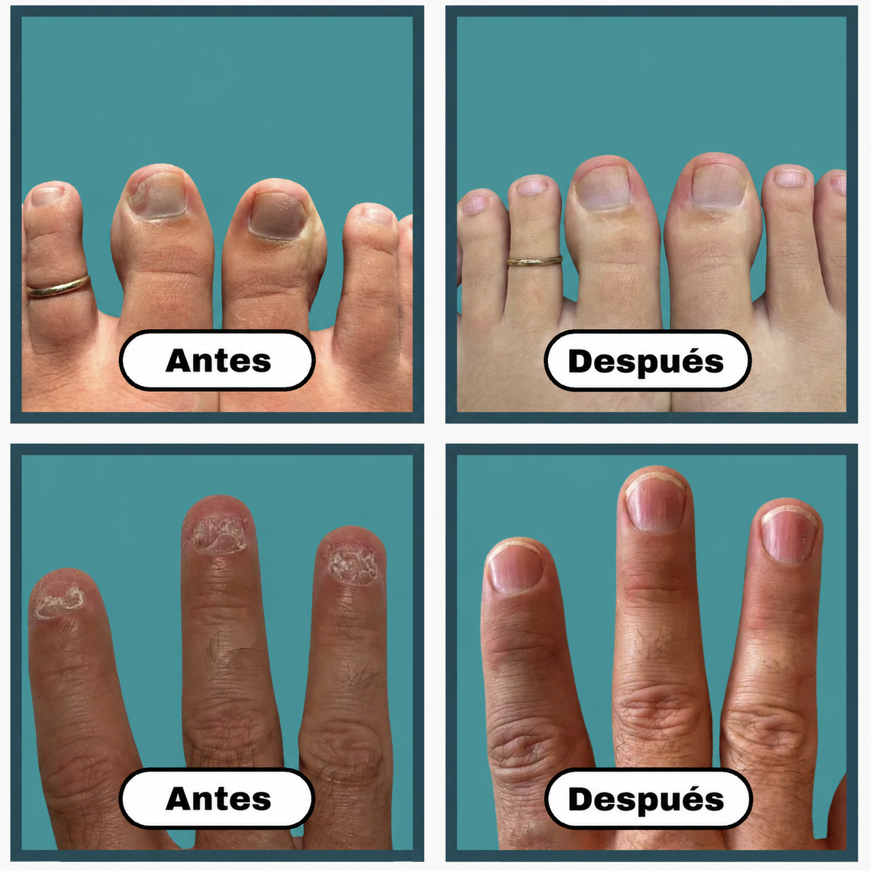 CuraVida - tratamiento con luz azul para los hongos en las uñas desde casa